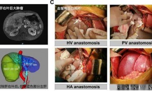 全球首例！中国团队成功将猪肝移植给活人