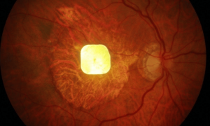 人类“芯片眼”来了？2毫米芯片植入眼球，失明老年人重见光明